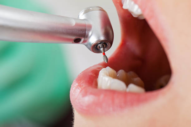 Best Emergency Wisdom Teeth Removal in Middletown, PA